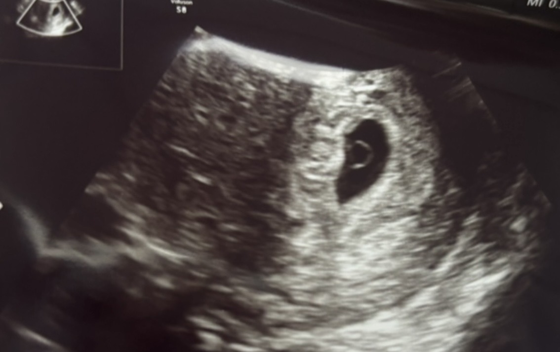 妊娠6週のエコー写真
